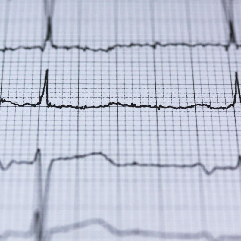 رسم قلب ECG